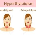 Thyroid Problems