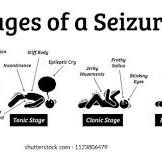 Pseudoseizure Psychogenic Non-epileptic Seizure (PNES)