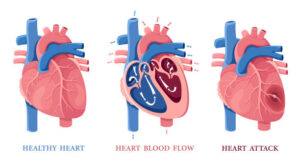 Heart Diseases